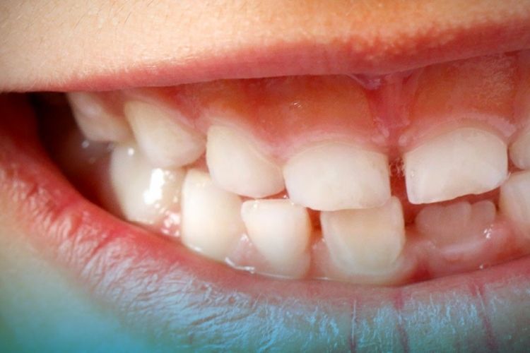 effet du fluor sur l'hygiène dentaire 